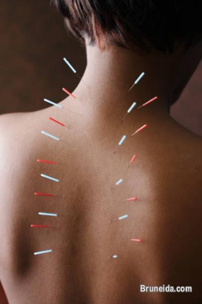 Acupuncture is a treatment that help with many conditions 8608625 - image 1